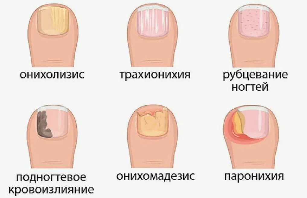 Почему у ребенка отслаиваются ногти 6 snimok jekrana 2024 05 30 v 17.30.51