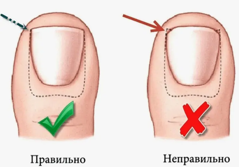 Почему у ребенка отслаиваются ногти 4 snimok jekrana 2024 05 30 v 17.28.41