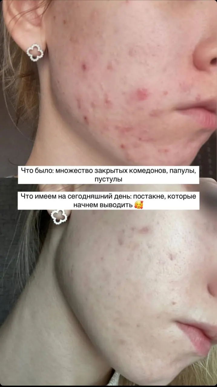 Уход за кожей лица для девочек-подростков: советы косметолога 6 whatsapp image 2025 04 13 at 18.55.06 1