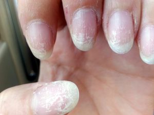 Травмы натуральных ногтей у 12 летних